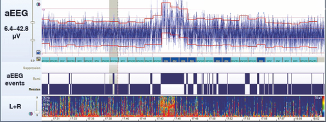 aEEG aEEG